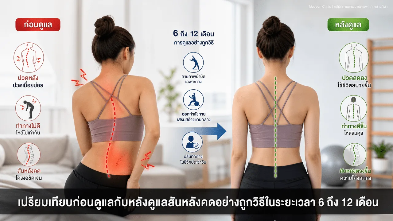 เปรียบเทียบก่อนดูแลกับหลังดูแลสันหลังคดอย่างถูกวิธีในระยะเวลา 6 ถึง 12 เดือน